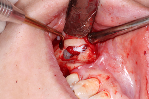 Science of Implant Surgery | Orthodontics, All-on-4® and Sleep Apnea